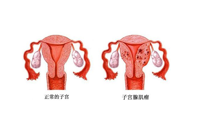 腺肌症是怎么回事