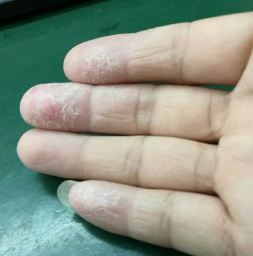 手掌长红点有刺痛感怎么办