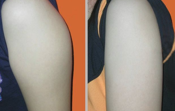 抽脂减肥疼吗 抽脂减肥过程疼吗
