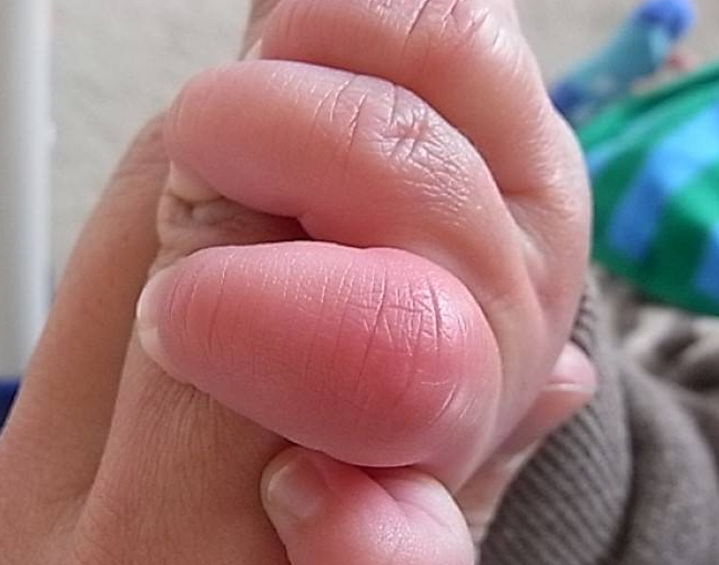 冻疮怎么办 教你食疗治疗方