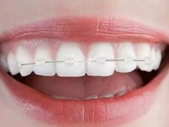 药物性牙龈增生不能吃什么 药物性牙龈增生吃什么食物