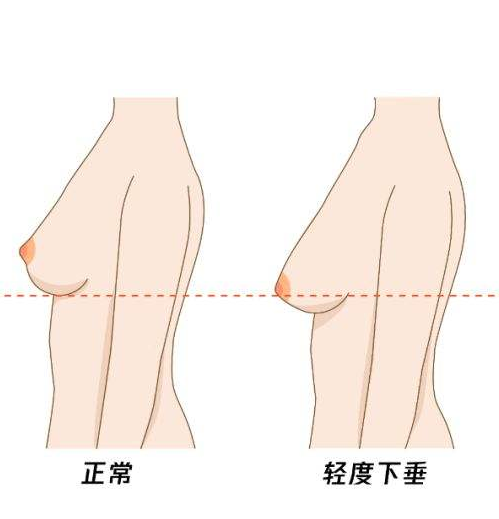 哪些坏习惯容易让胸部下垂   四大方法帮你矫正