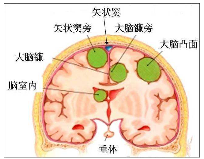 脑膜瘤症状是什么 脑膜瘤会不会遗传