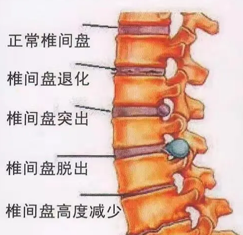椎间盘膨出是什么意思 椎间盘膨出有什么症状