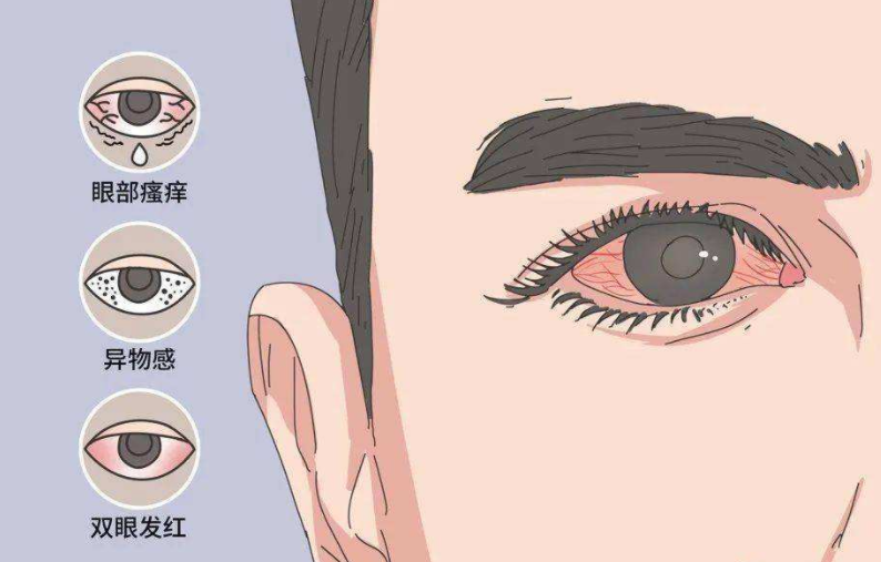 结膜炎会传染吗 结膜炎要隔离吗
