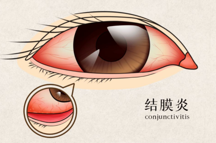 结膜炎是什么引起的 结膜炎有什么症状
