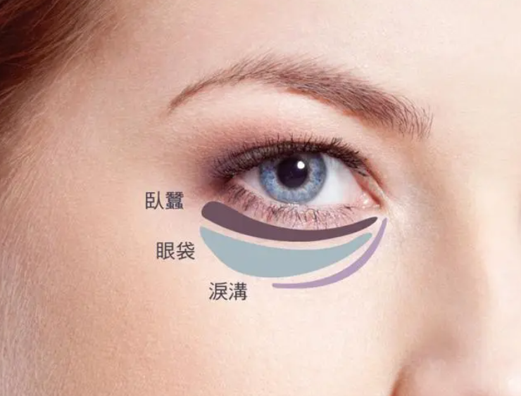 什么是眼袋 眼袋是怎么形成的