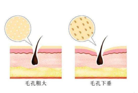 毛孔越来越粗大怎么办 这么做缩毛孔