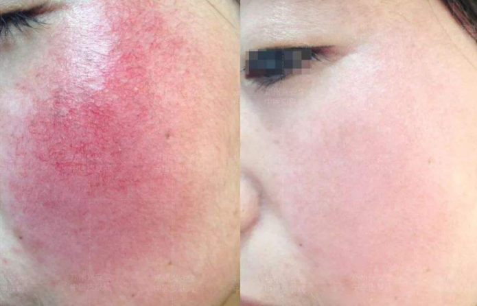 脸上很多红血丝怎么办 5种方法有效缓解