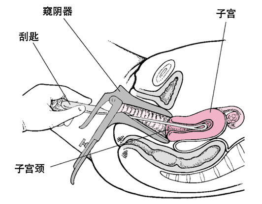 刮宫过程