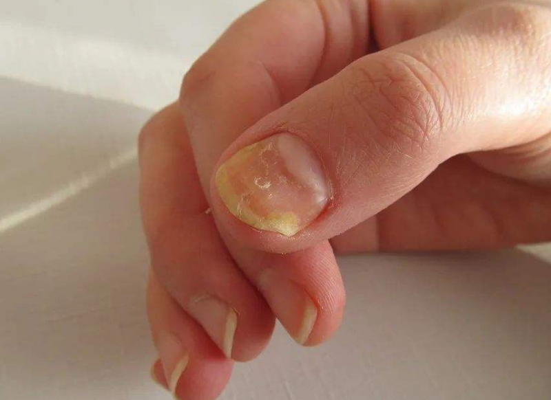 手指甲有凹陷是怎么回事警惕以下疾病引起的手指甲有凹陷病因