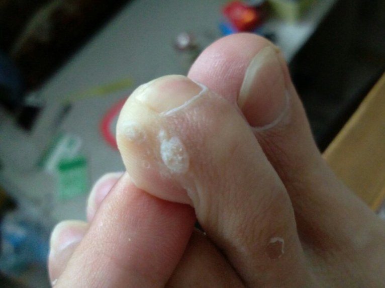 鸡眼怎么根治 治疗鸡眼的偏方