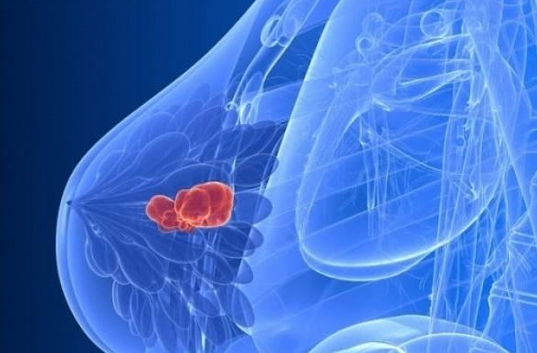 乳腺增生治疗方法 乳腺增生健康食疗方