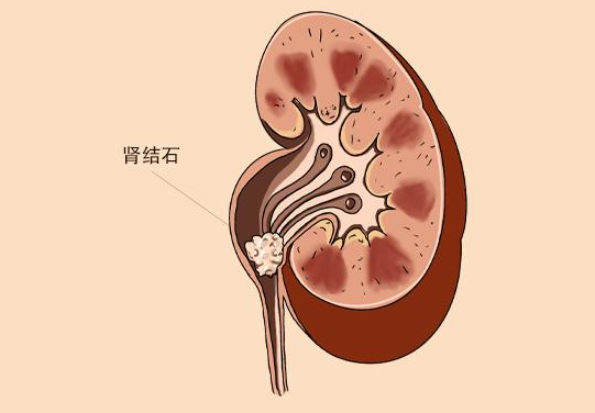 肾结石饮食注意 肾结石少吃油腻食物及粗粮