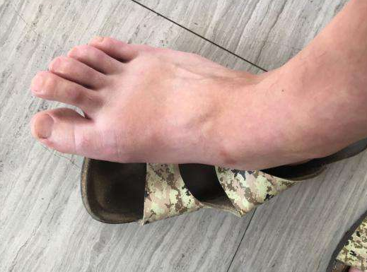 痛风不能吃什么 痛风病人的饮食安排