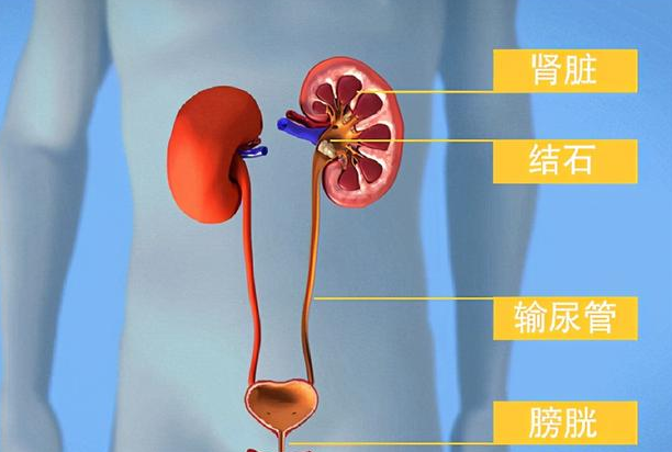 肾结石怎么治最好 肾结石的偏方有哪些？