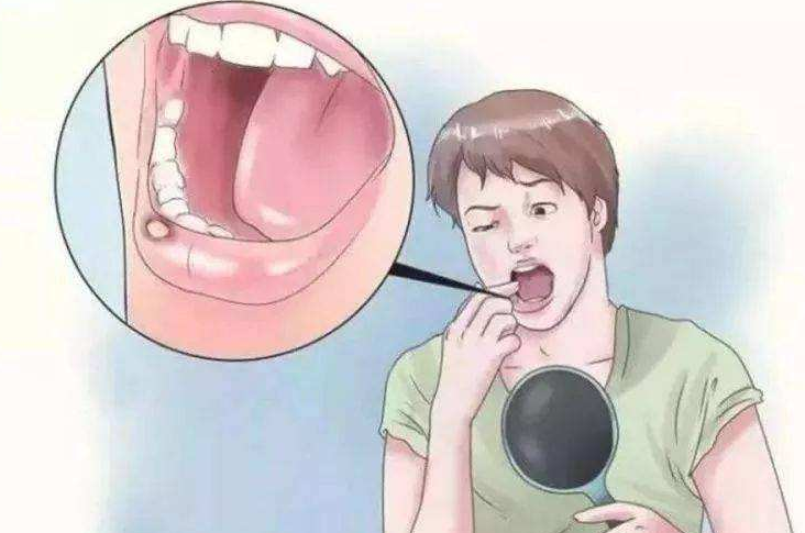 口腔溃疡的原因 口腔溃疡是如何引起的？