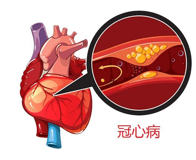 冠心病的饮食 冠心病饮食中需要哪些营养？
