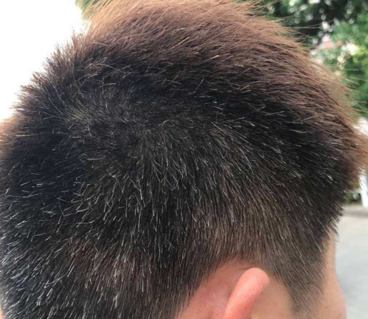 少年白发 防白发饮食调理以及白发原因