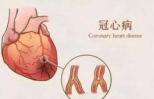 冠心病的注意事项 冠心病人应该如何饮食？