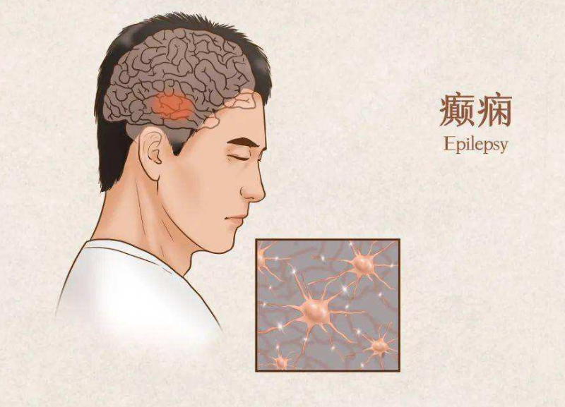 癫痫病人不能吃什么 成人癫痫饮食禁忌