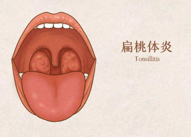 扁桃体发炎，药膳来帮你