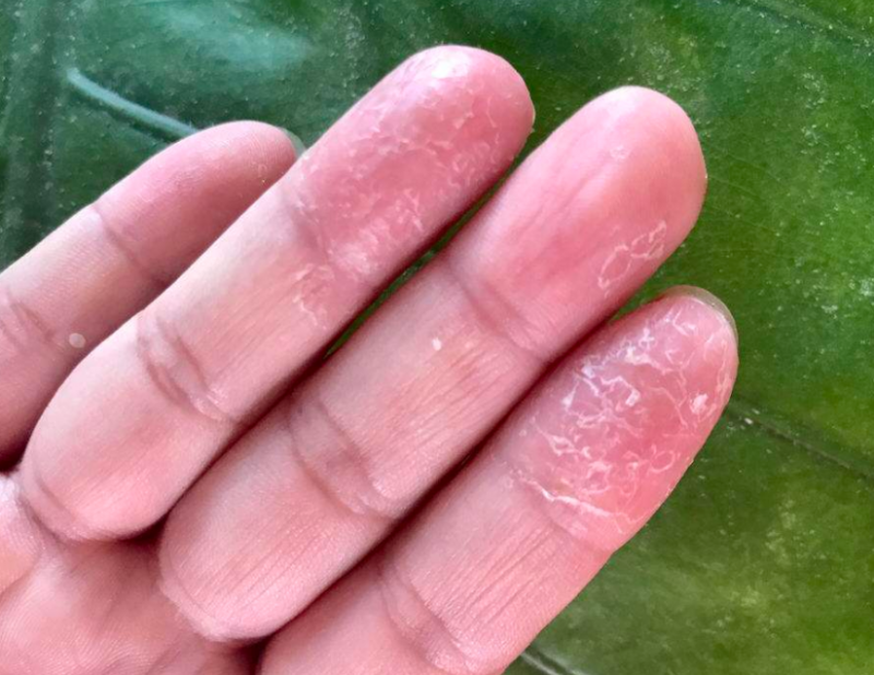 换季手脱皮是什么原因 手脱皮可以撕吗