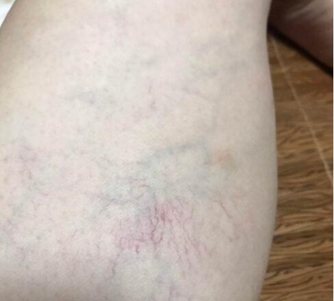 腿上有红血丝是什么原因造成的 腿上有红血丝怎么去除