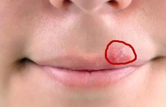 嘴唇上长疱疹怎么快速消除 嘴唇上长疱疹是什么原因引起的