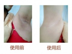 腋窝发黑是怎么回事？分享胳肢窝黑迅速变白小妙招
