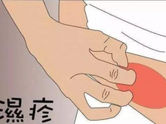 湿疹怎么治好得快用什么药膏