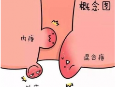 内痔疮怎么治好得快？内痔疮用什么药治疗效果好