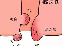 内痔疮用什么药效果好?内痔疮的最佳治疗方法