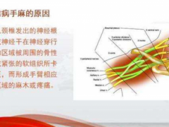 手麻怎么治疗？睡觉手麻是什么原因引起的？可能是它