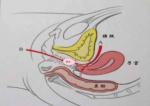 什么是&ldquo;石女&rdquo;？先天&ldquo;无阴道&rdquo;是咋回事？和正常女性有何区别？