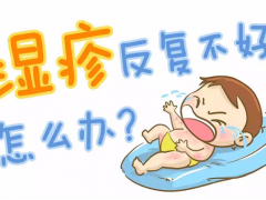 人一旦得了湿疹就一辈子有吗？大人湿疹抹什么药膏好得快