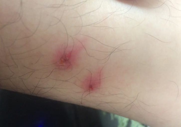 床上螨虫咬的症状是什么 被螨虫咬之后怎么处理