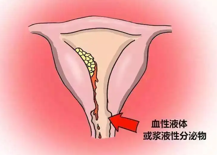 经期不规则出血是什么原因 妇科专家告诉你