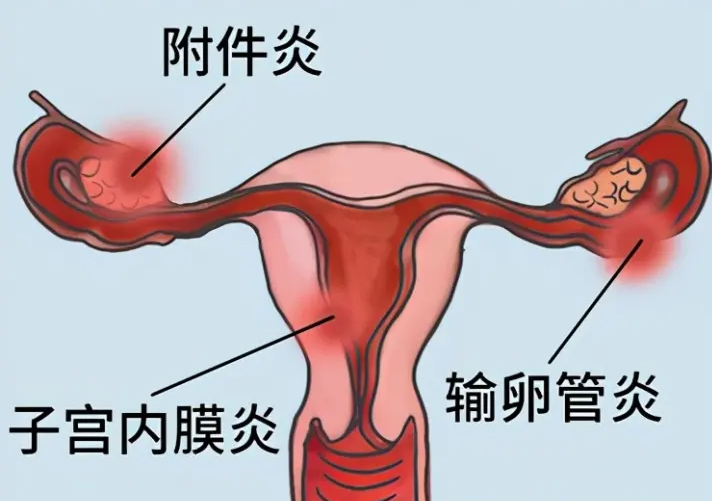 患盆腔炎会影响胎儿吗 一般为不良影响需避免
