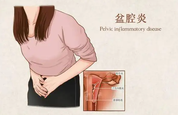 如何及早发现盆腔炎 教你三招自查盆腔炎