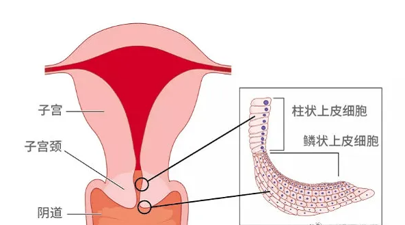 宫颈糜烂如何避免过度治疗 分享避免过度治疗的方法
