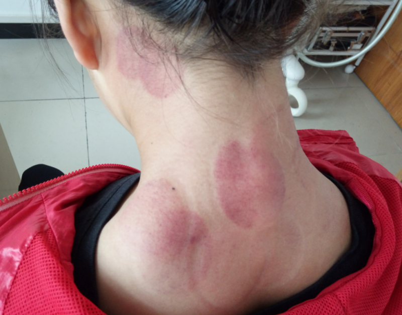 出痧的颜色代表什么 开背出痧了是排毒吗