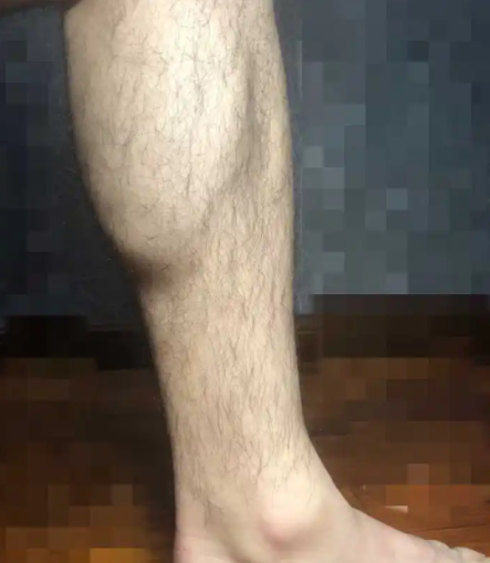 腿毛会自然脱落吗 做了永久脱毛会不会再长出来