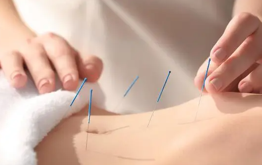 曝光针灸减肥适合人群 针灸减肥也要对症治疗