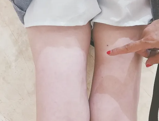 抽脂后疼痛感多久恢复 缓解疼痛是关键
