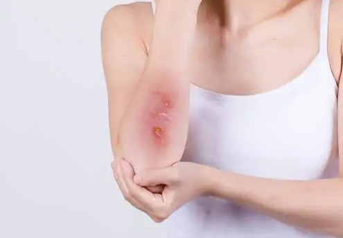 为什么伤口快好的时候会很痒 伤口愈合很痒怎么止痒