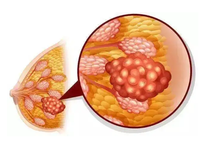 夏枯草治乳腺增生效果怎么样    这样吃轻松告别疾病