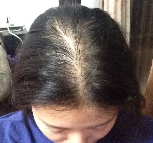 女性脂溢性脱发治疗方法 无痕植发的优点介绍