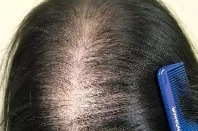 女性脱发吃什么好 女人吃这些补肾防治脱发