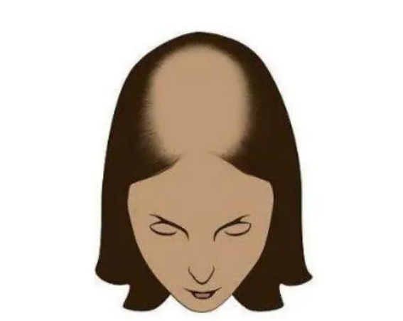女性脱发的原因有哪些 警惕避孕药危害